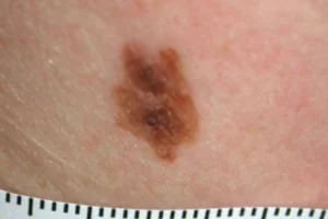 خال دیسپلاستیک :تعریف، علل، علائم و راهکارهای درمانی