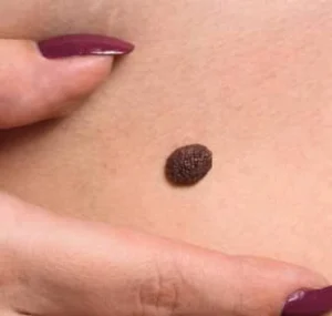 انواع خالهای پوستی: علل، علائم و روشهای درمان