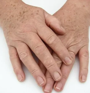 لک‌های خورشیدی و آسیب ناشی از آفتاب: علل، پیشگیری و درمان