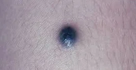 خال آبی: تعریف، علل، علائم و راهکارهای درمانی