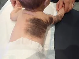 خال مادرزادی: علل، علائم و روش‌های درمان