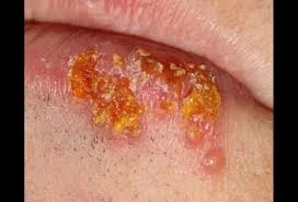 ویروس تبخال : علائم، روشهای انتقال و راههای پیشگیری