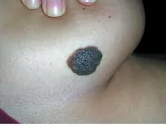 خال مادرزادی: علل، علائم و روشهای درمان