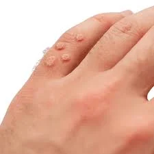 زگیل: علل، انواع و روشهای درمان