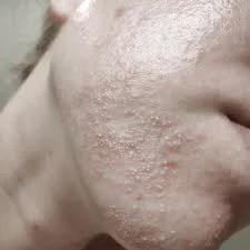 آکنه قارچی (مالاسزیا فولیکولیتیس): علل، علائم و روش‌های درمان