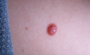 خال اسپیتز: تعریف، علل، علائم و راهکارهای درمانی