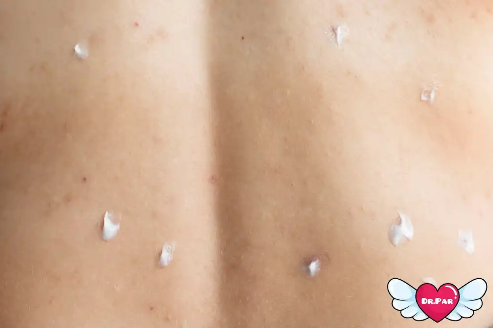 دلایل بروز جوش بدن